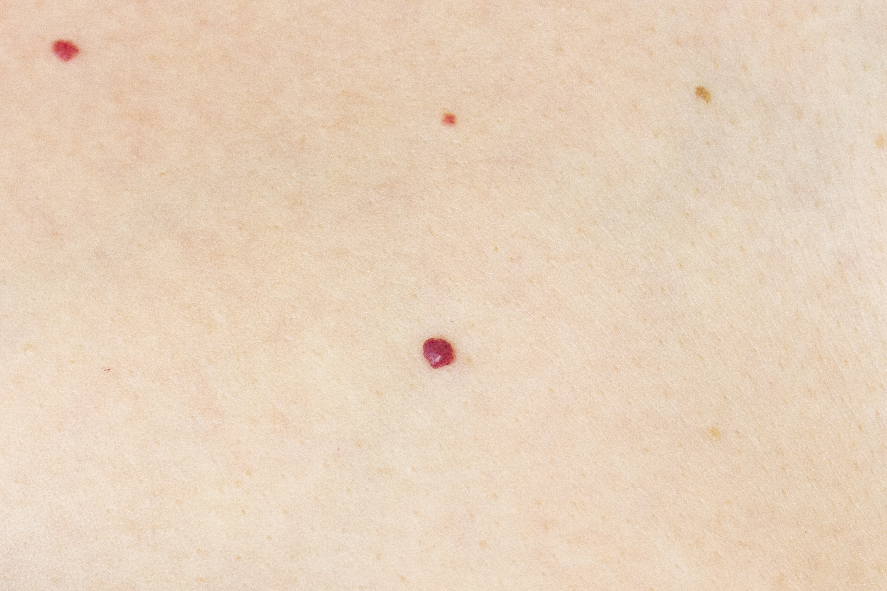 Angiomas
