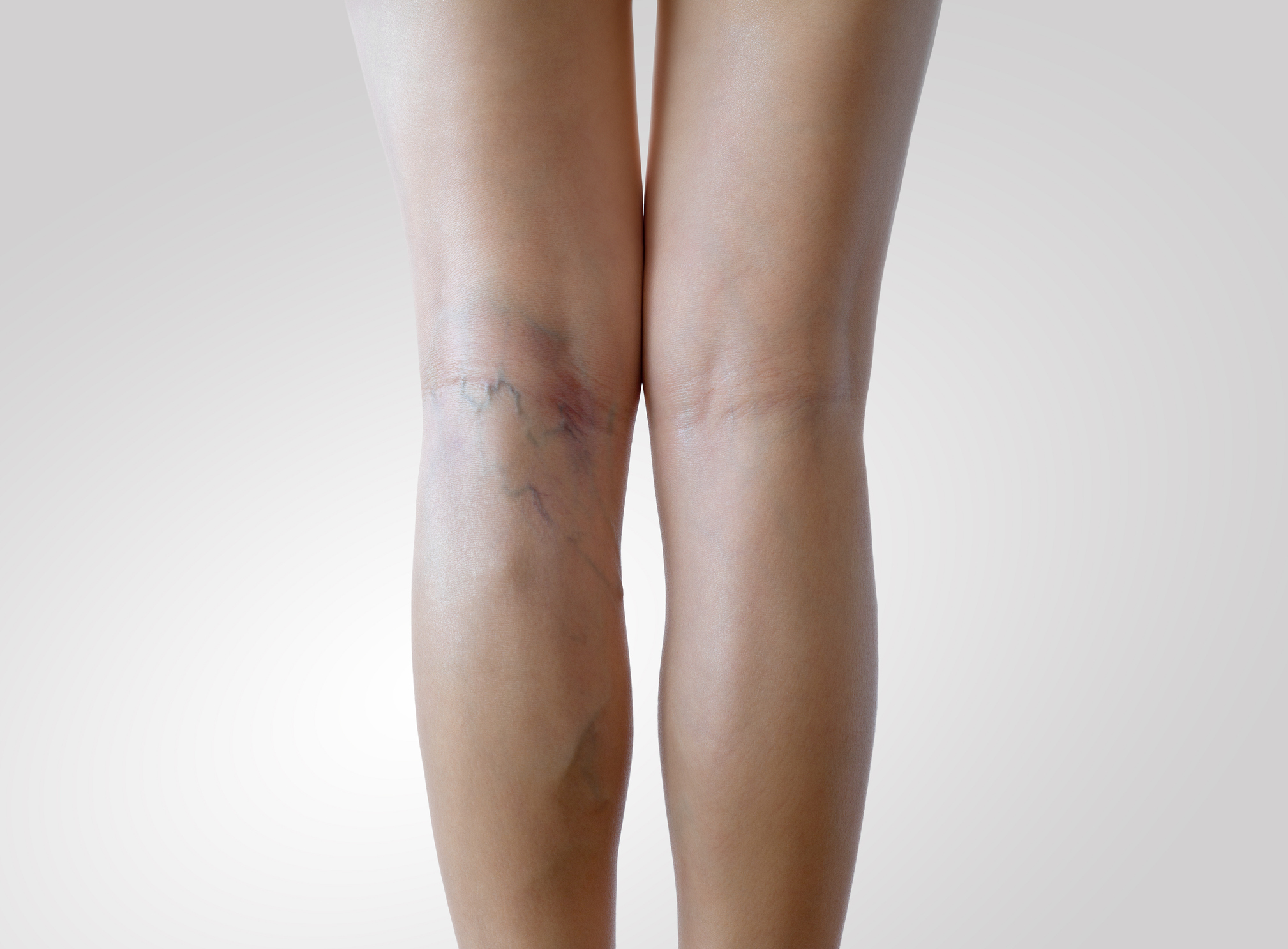 Leg varicosities